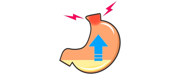 逆流性食道炎の基礎知識